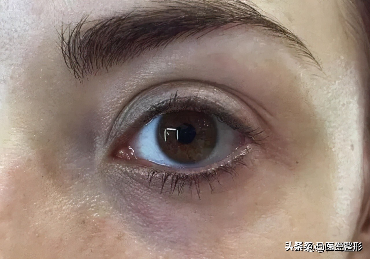 不熬夜黑眼圈还是去不掉是咋回事,很多年的黑眼圈了怎么才能淡化