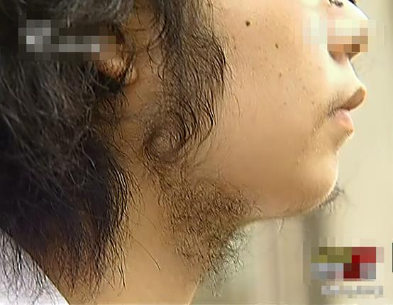 花季少女意外车祸后长胡子,14岁妙龄少女车祸后长胡子