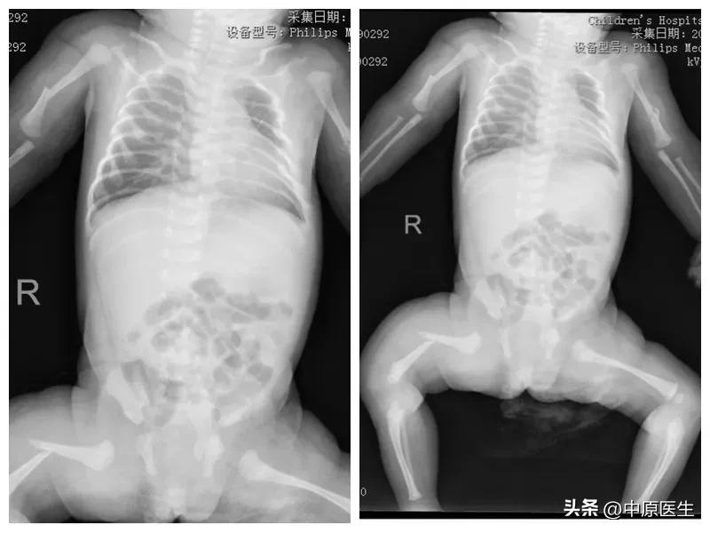 婴儿如果出现骨折会有什么症状,婴儿可疑骨折什么症状