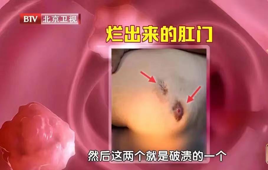 屁股洗不对，痒、痛、痔疮…都可能找上门！今天教你正确护理法