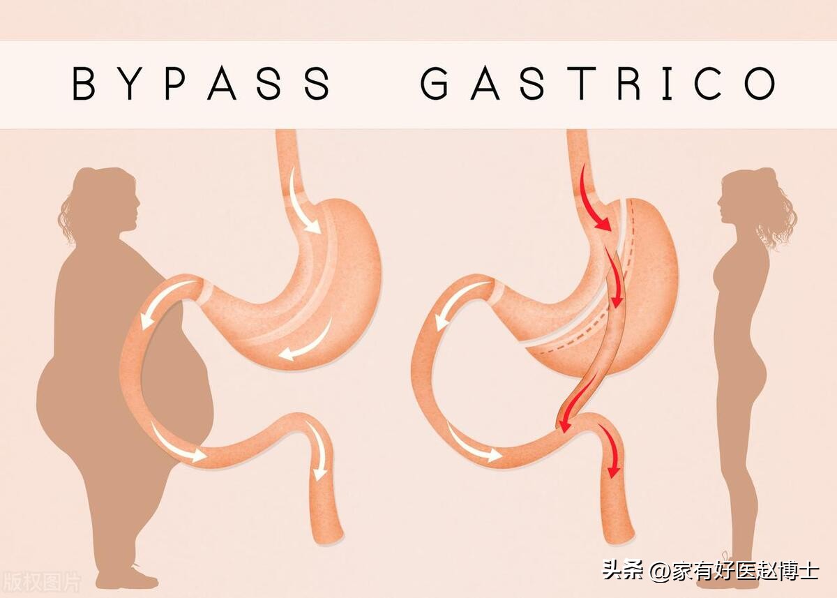 “缓解/逆转”2型糖尿病，具体有三种方法！适用的情况各不相同
