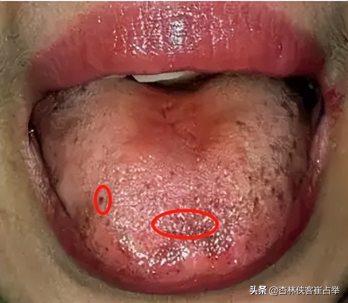 胃病最正确的治疗方法,胃病的三种疗法