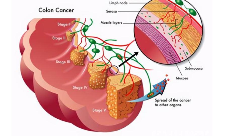 肛门有小肉疙瘩怎么治疗,肛门长小肉疙瘩怎么治疗