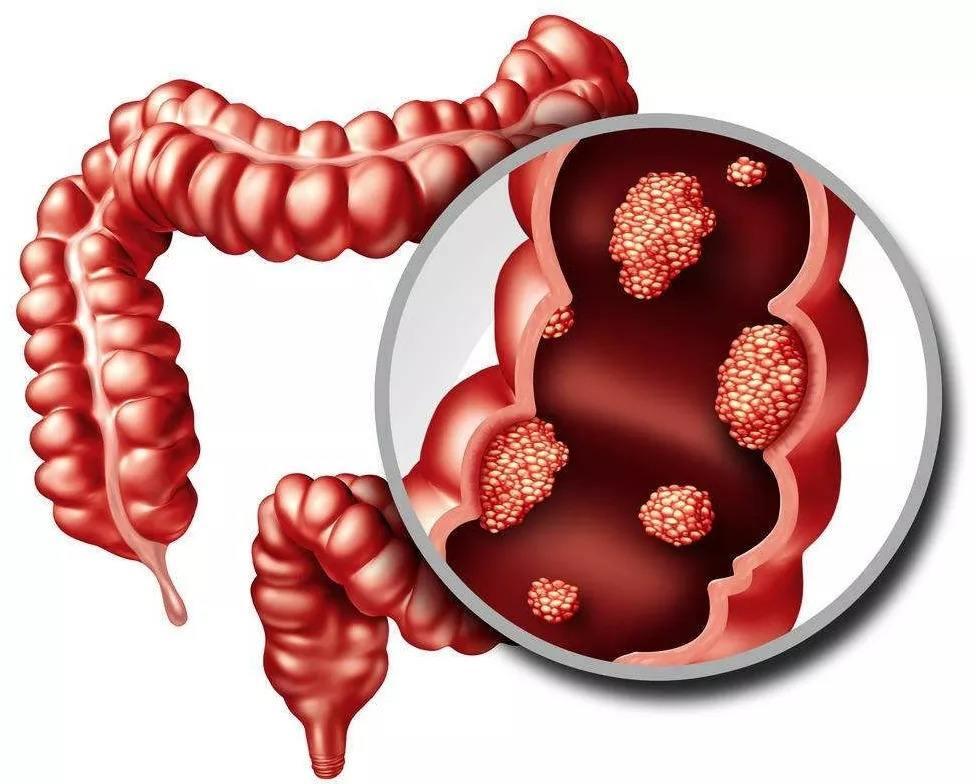 从炎症到癌症大约要几年时间,炎症发展到癌症需要多长时间
