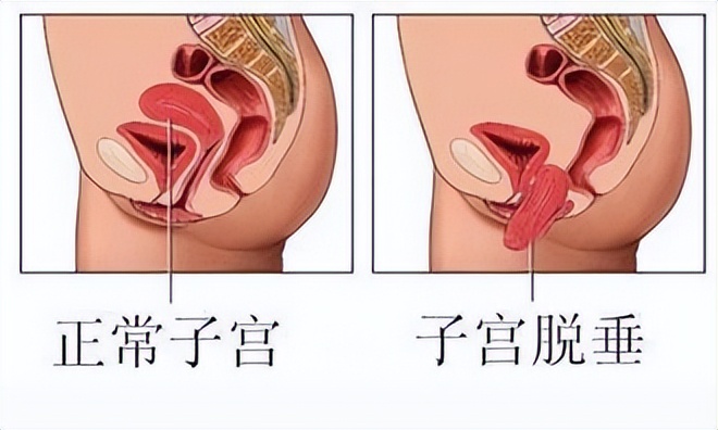 大妈上厕所正用力，身体掉下一块“肉”？医生坦言：这是你的子宫
