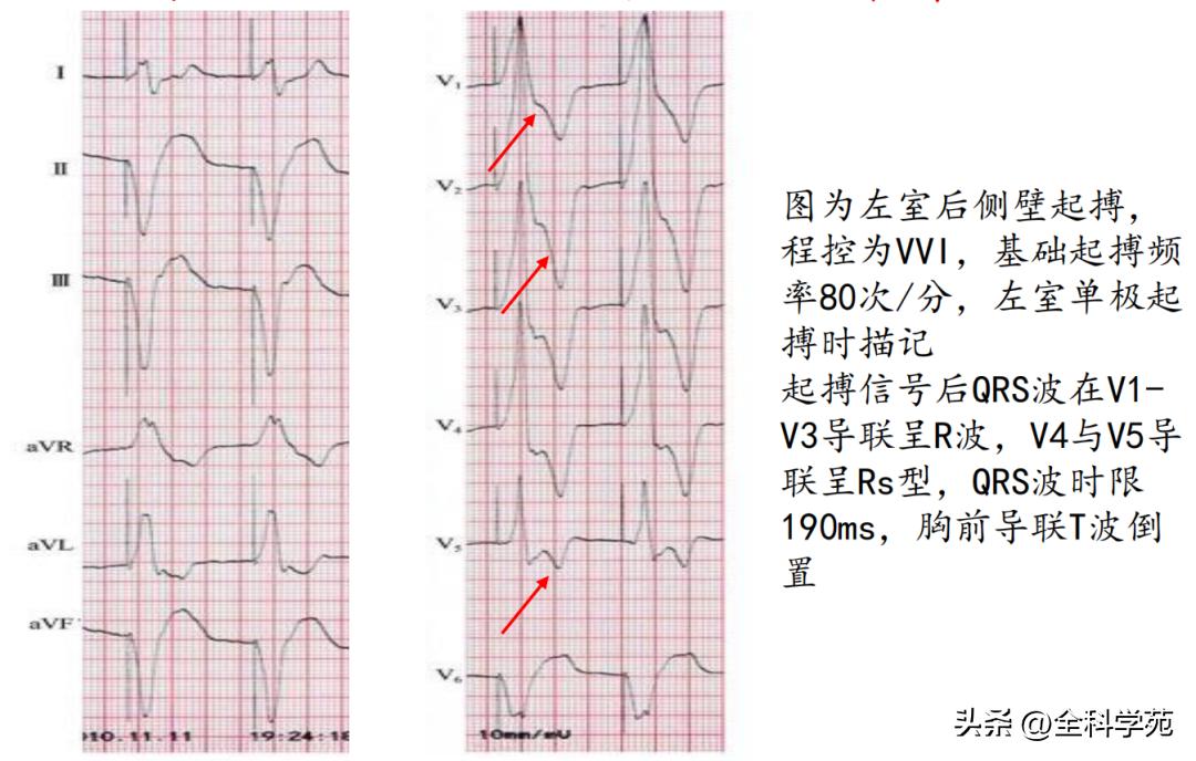 t波倒置三种常见原因,t波低平倒置有事吗