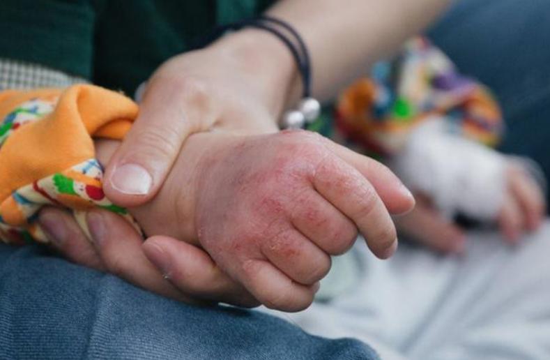 医学科普湿疹做好这几点减少复发,谈谈湿疹的中医药防治与调养