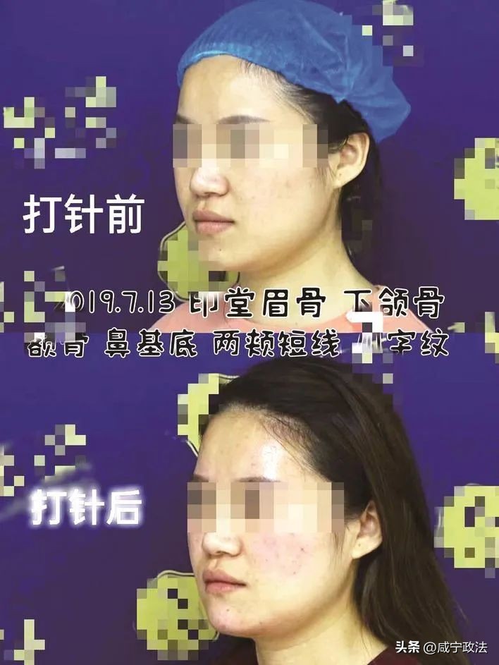 女子做医美后皮肤坏死院方回应,女子整形索赔10万