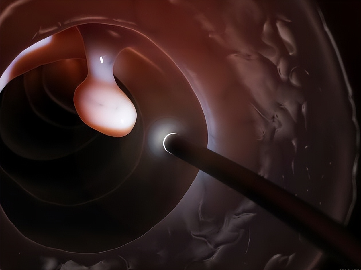 普通肠镜和无痛胃镜有什么区别,无痛肠镜与普通肠镜有啥区别