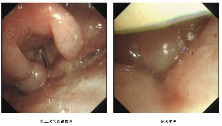 「市一专科」元宵佳节，气管镜室为何传来哭声？
