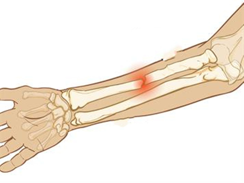 手臂疼痛的预兆是什么病,手臂疼痛怎么处理用什么药
