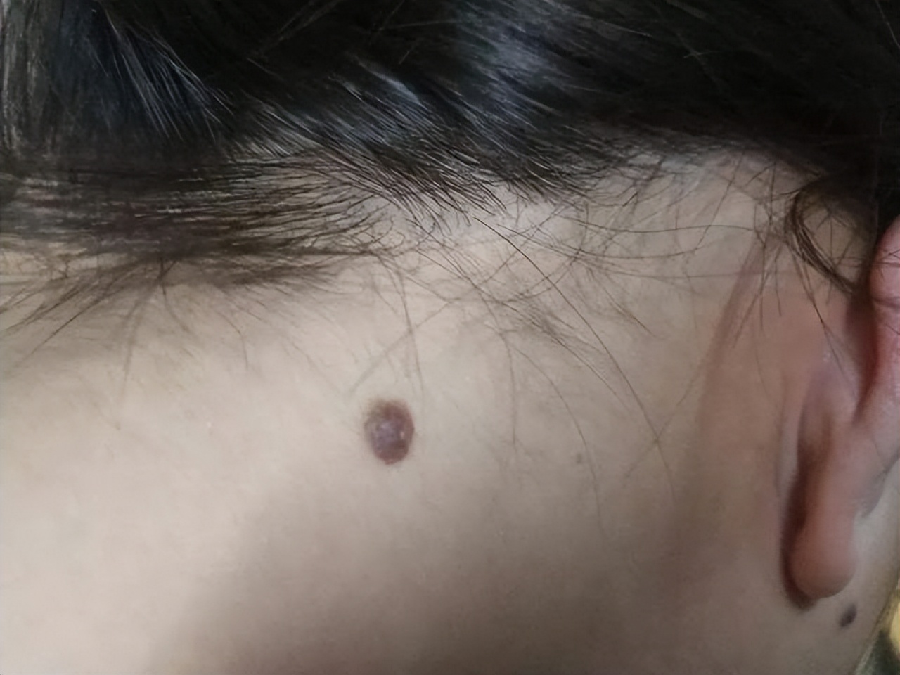 身上的痣有5个特点要当心,痣黑如漆与深黑死痣区别