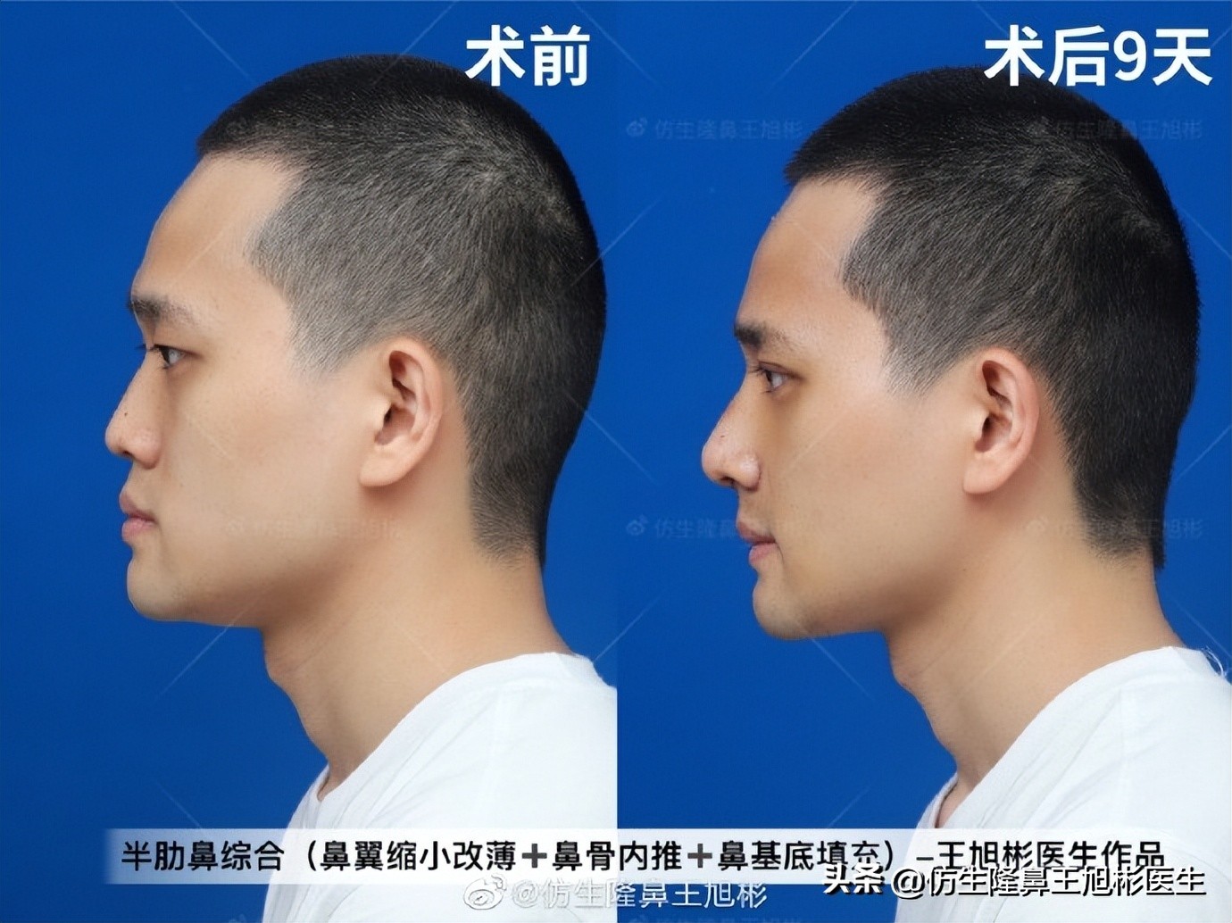 鼻基底填充会移位到鼻孔吗,鼻基底填充假体会拉长人中吗