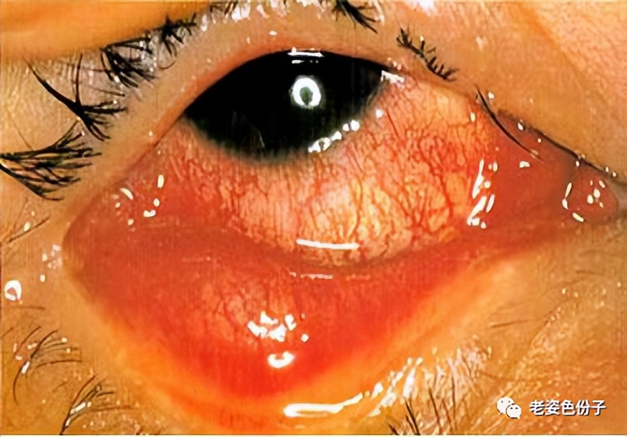 疫情期间鼻子出血要去医院吗,疫情期间眼病要立即治疗吗