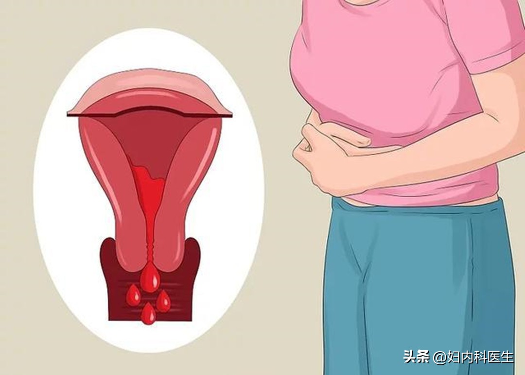 子宫长息肉是癌症的前兆吗,子宫颈长息肉是什么原因引起的