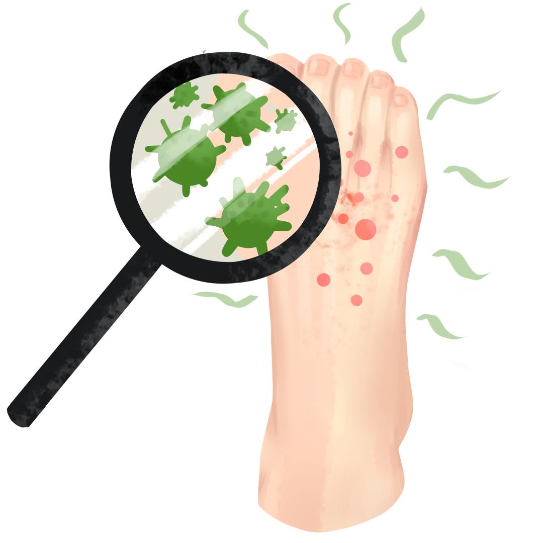 夏天脚气发作脚痒难忍用什么药膏,脚气痒脱皮有小水泡治疗小妙招