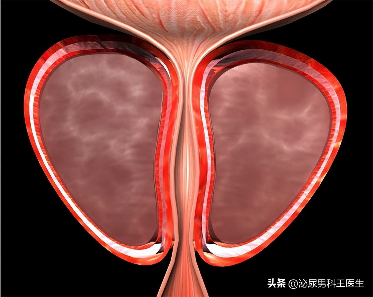 前列腺癌晚期骨转移症状有哪些,前列腺癌晚期患者临终前15个症状