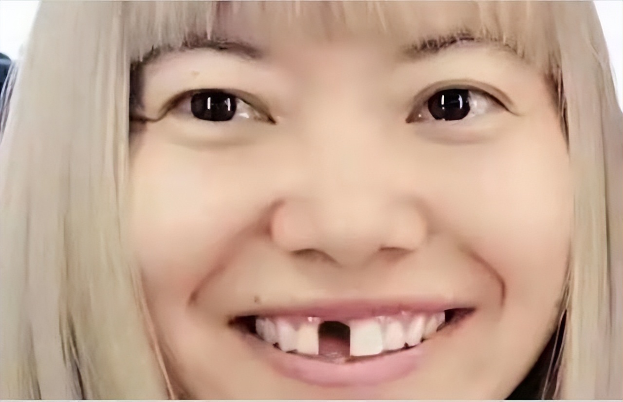 烤瓷牙牙龈发黑的明星,娱乐圈真的都是烤瓷牙吗