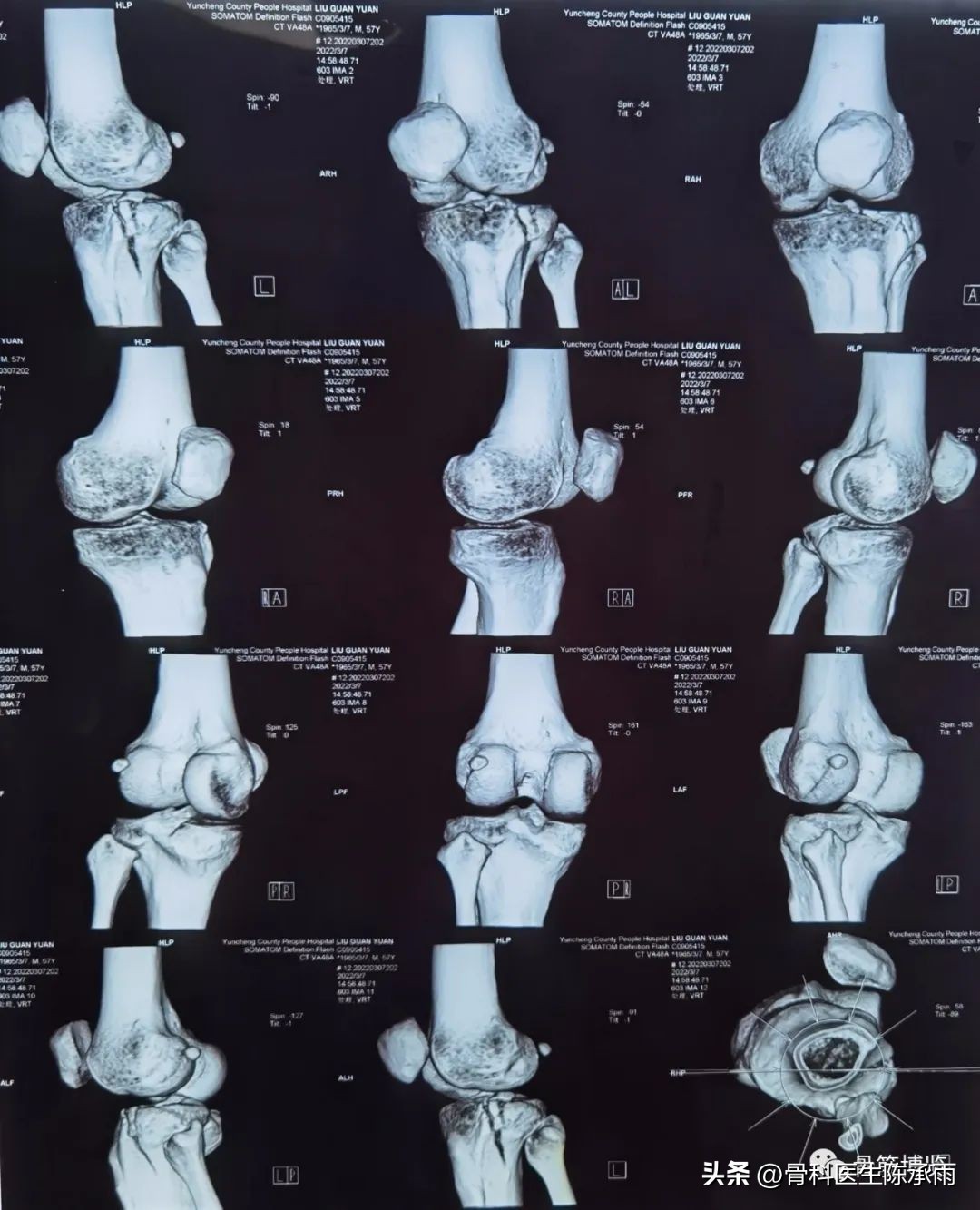 膝关节胫骨平台骨折,最近胫骨平台骨折视频