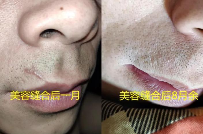 大面积外伤疤痕怎么修复,面部手术留下的蜈蚣疤痕怎么修复