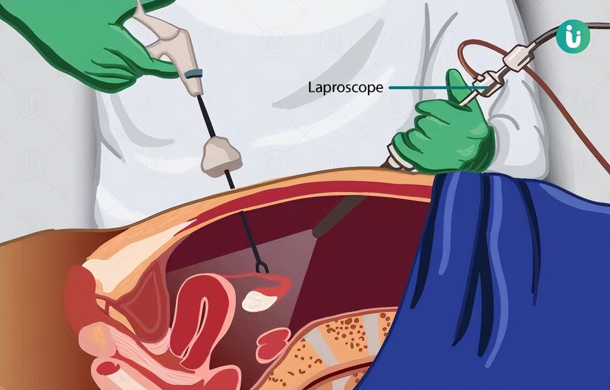 那些切了子宫的女性，后来都怎么样了？