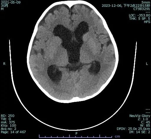 4岁男童体内有只米老鼠,2岁小孩脑门上起了2个小疙瘩照片