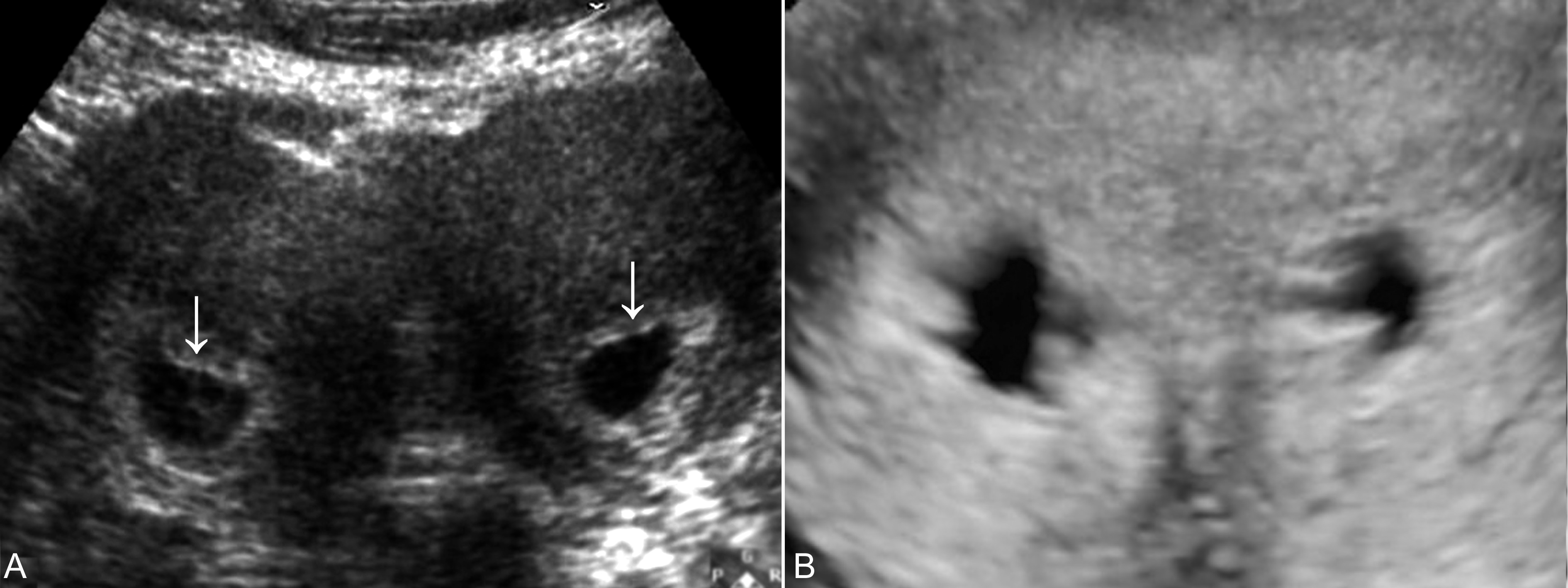 明明白白做超声33-13：双子宫妊娠