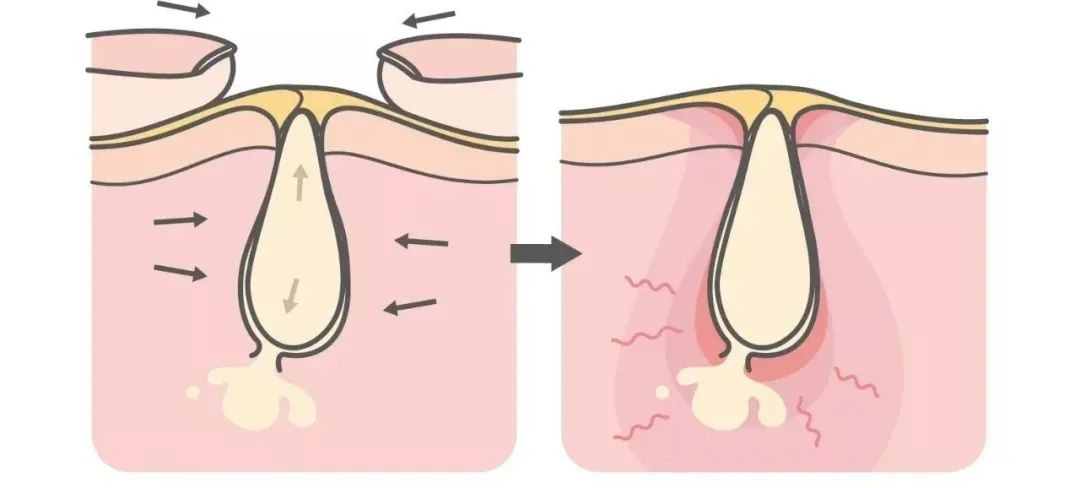 怎样才能彻底跟黑头说拜拜呢,科普如何让烦人的黑头消失