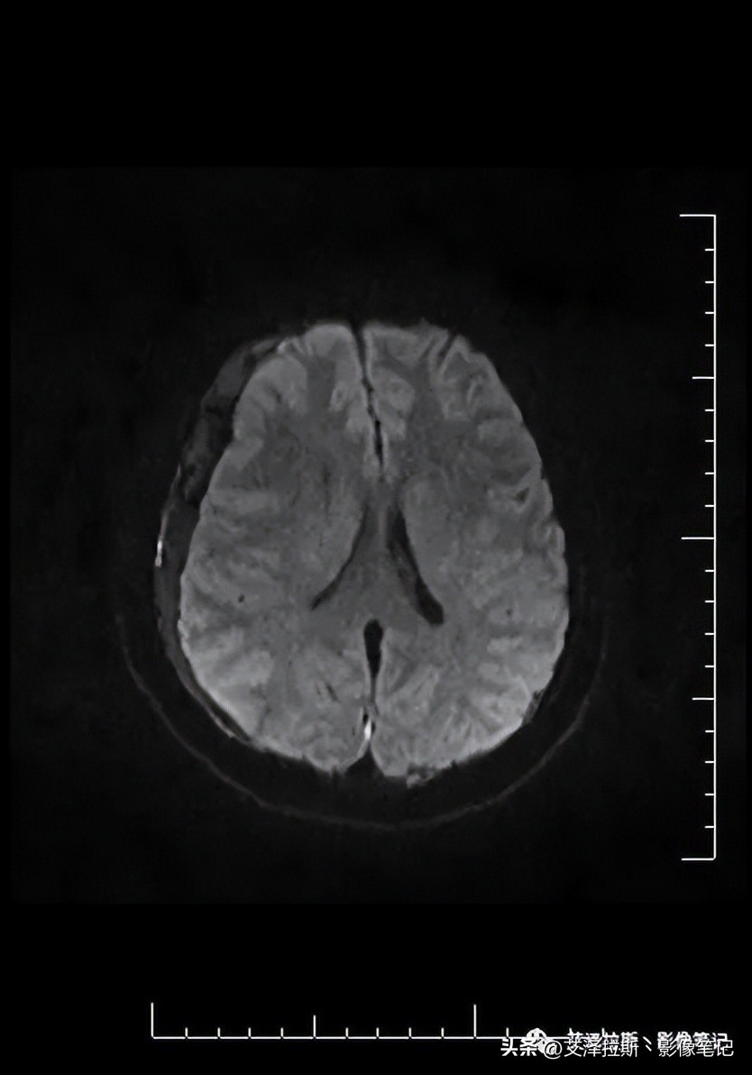 中枢性低通气综合征,中枢性低通气综合征可以治愈吗