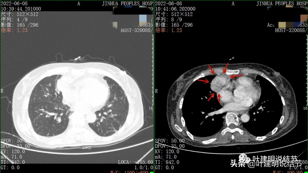 这位老乡，乏力来查，查出这么大个的纵隔肿瘤！会是什么呢？