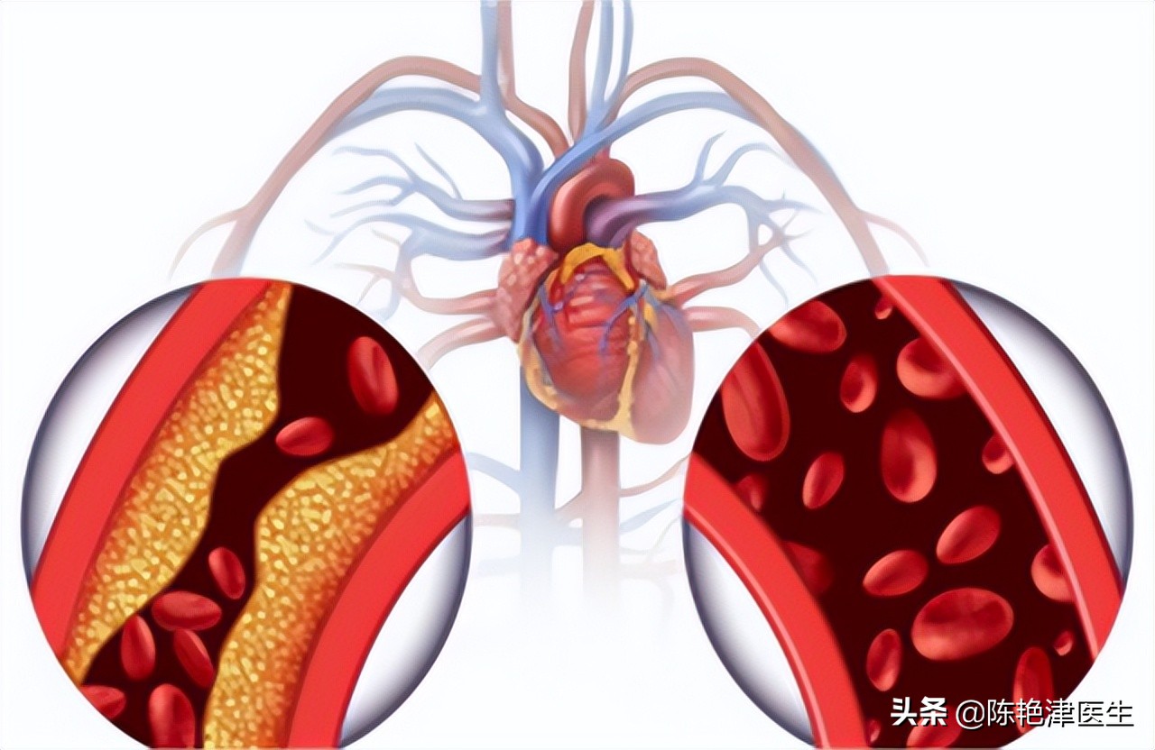 严重的心肌缺血吃什么药最好,心肌缺血吃什么药最好有效