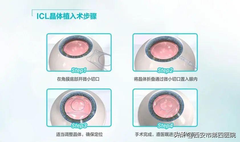 权威眼科专家告诉你:ICL有啥优点?你适合做吗?