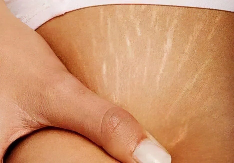 皮肤一道道纹路怎么回事,皮肤上的纹路到底怎么回事