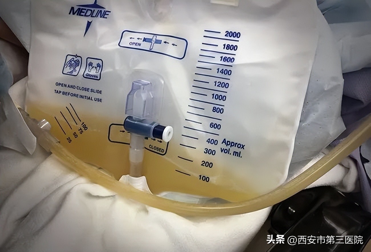 留置导尿过程中的护理宣教,长期留置导尿管家庭护理