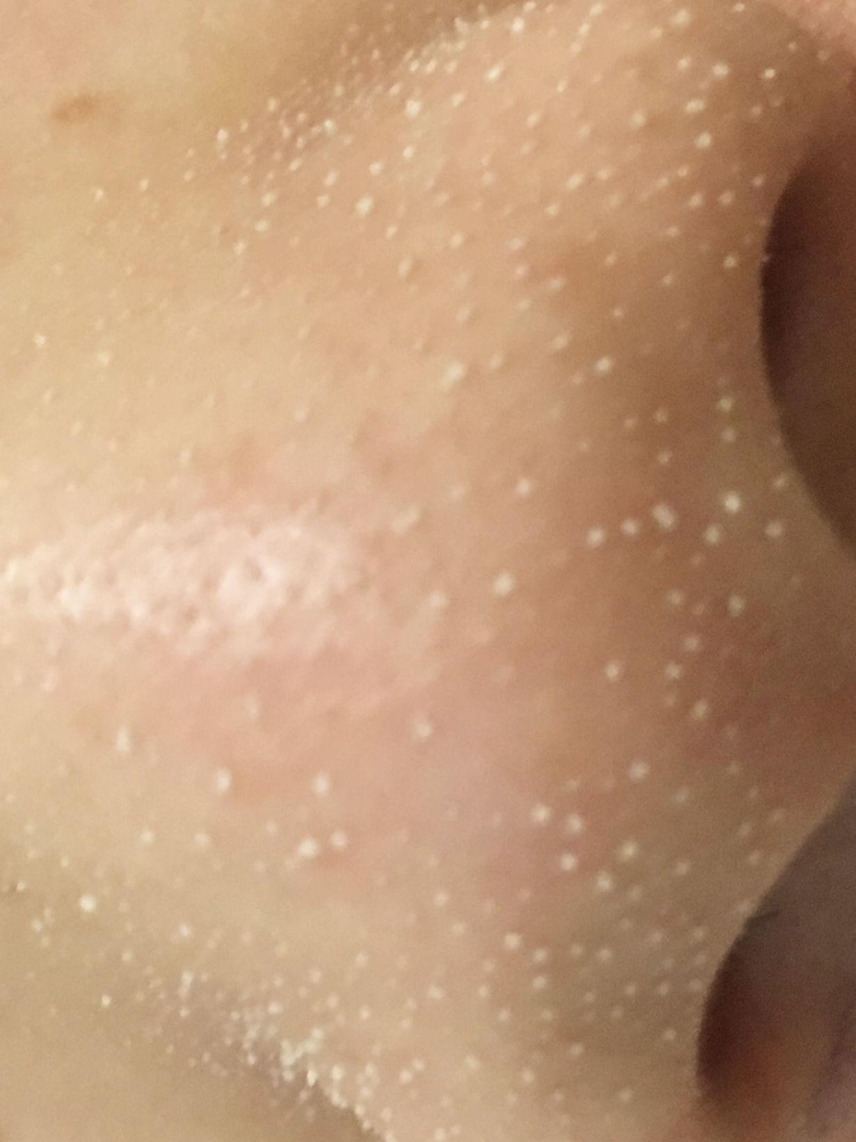 鼻子毛孔堵塞凸起有油脂粒,鼻子毛孔粗大有油脂粒怎么办