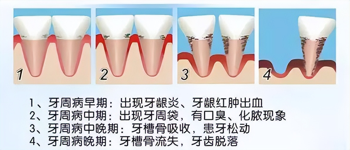 牙齿松动很严重怎么把牙拔下来,中年人牙齿完全松动自己能拔吗