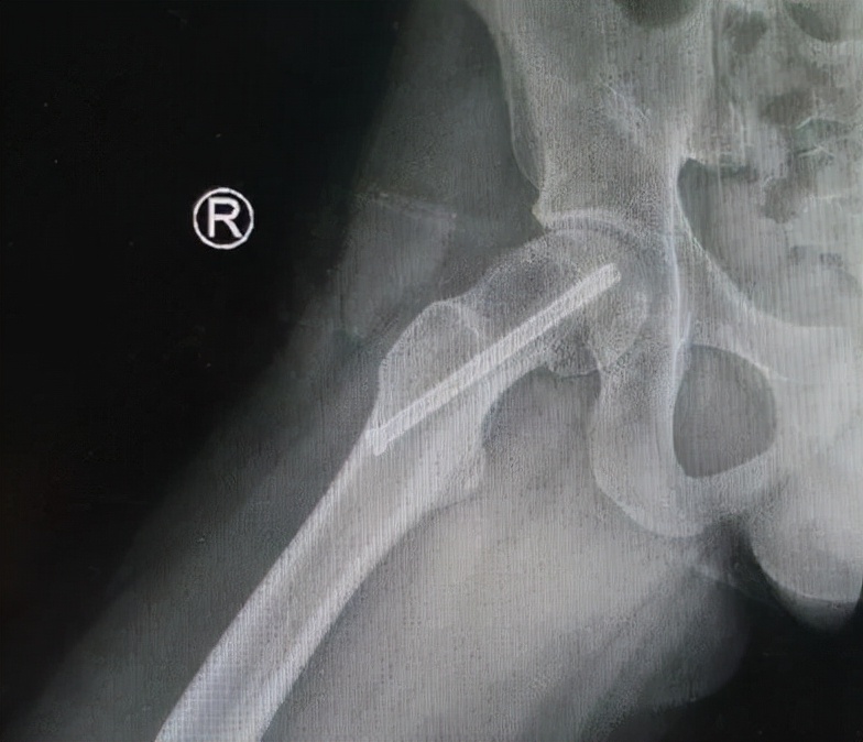 小儿骨科科普类短视频,股骨头骨骺滑脱中医手法治疗