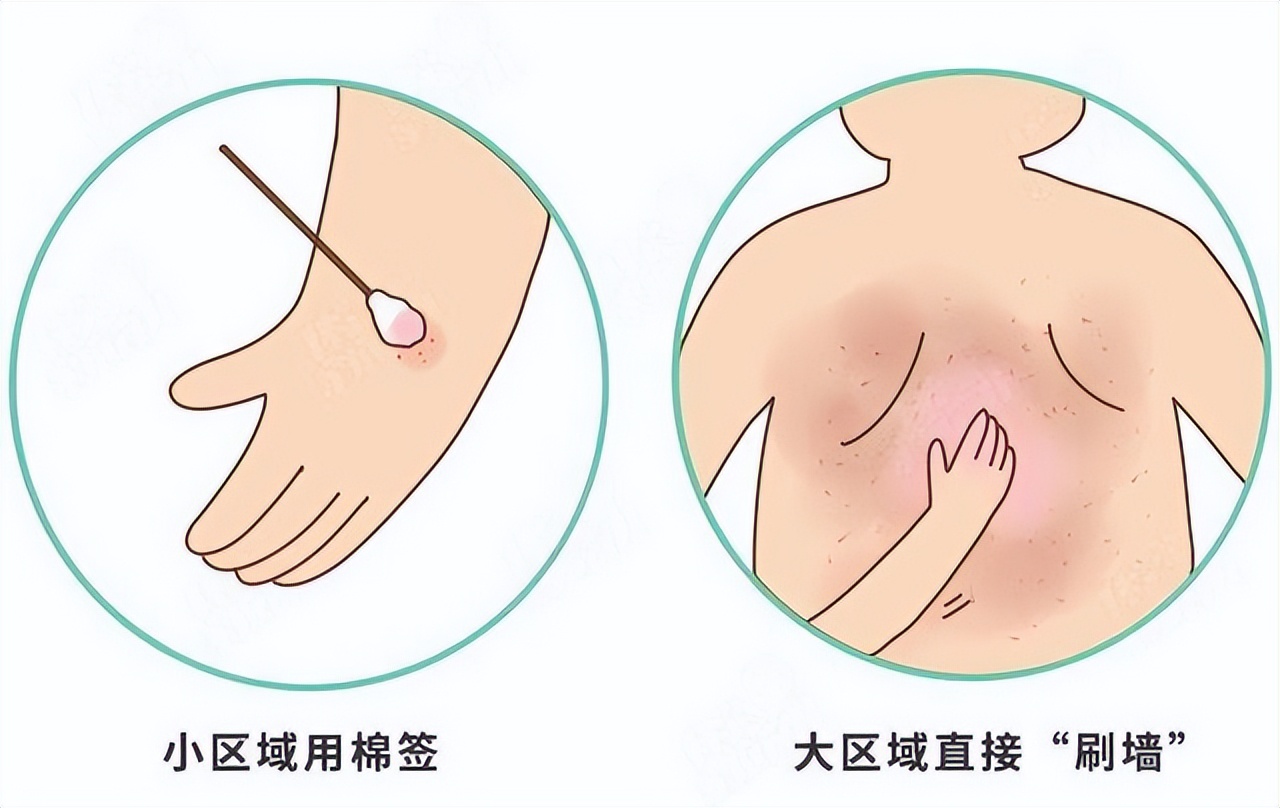 炉甘石洗剂功效多少钱一瓶,世卫组织推荐炉甘石