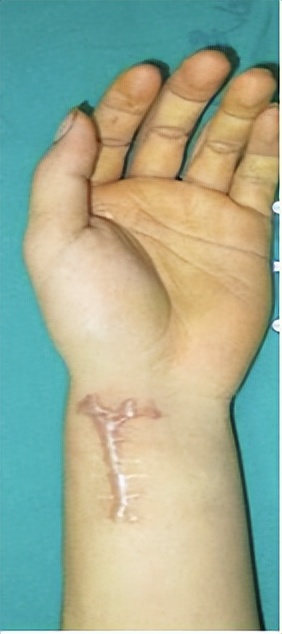 桡骨远端骨折的护理方法,手腕桡骨远端骨折后的恢复过程