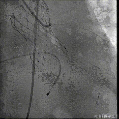 病例回顾与分享,腹膜后血肿介入治疗
