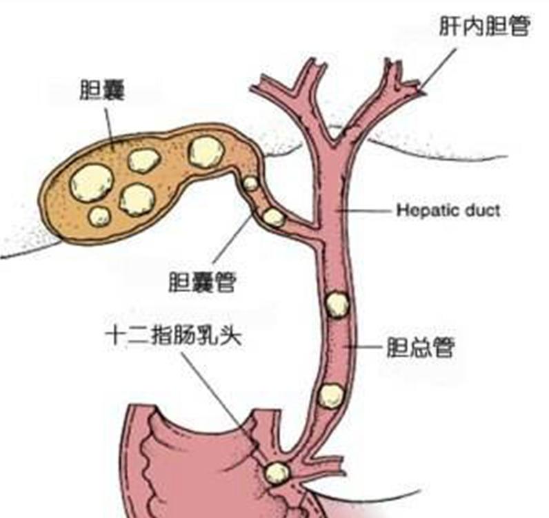 为什么胆有结石必须摘了,胆结石医生为什么都建议割胆