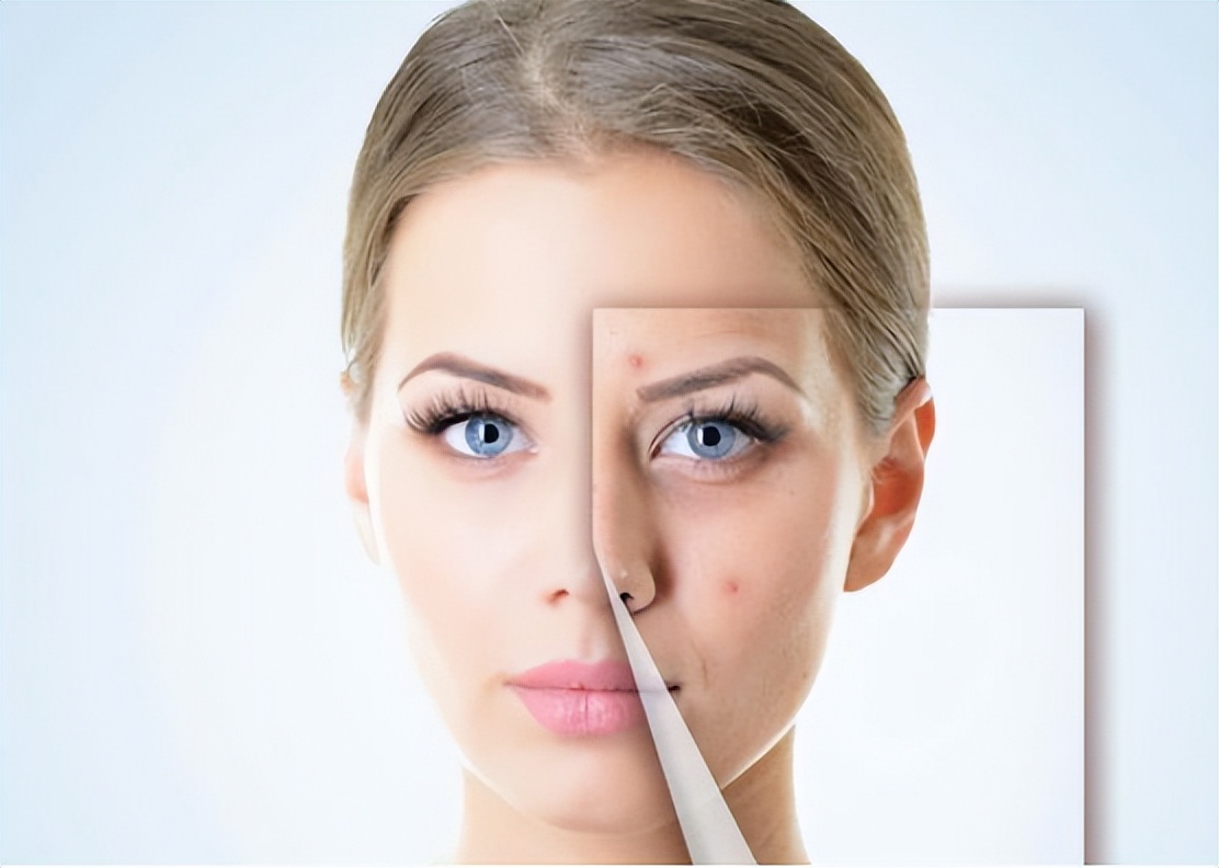 脸部皮肤破了可以刷酸吗,面部刷酸灼伤皮肤怎么恢复