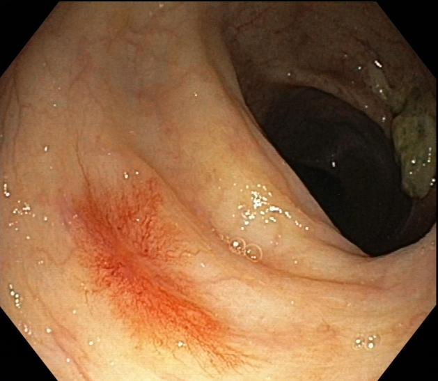 肠道内惊现蜘蛛痣？