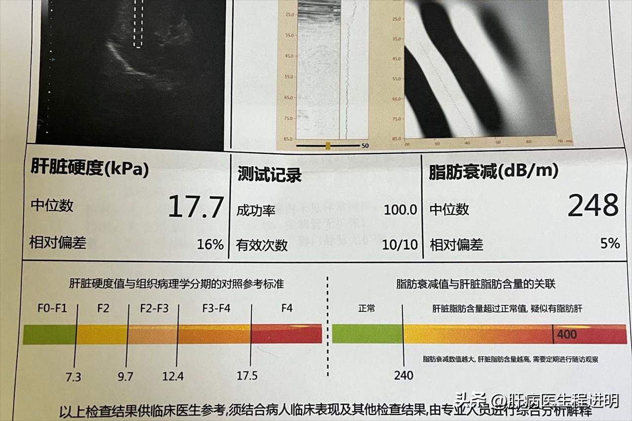 乙肝被彻底改变,乙肝规范治疗能活多少年