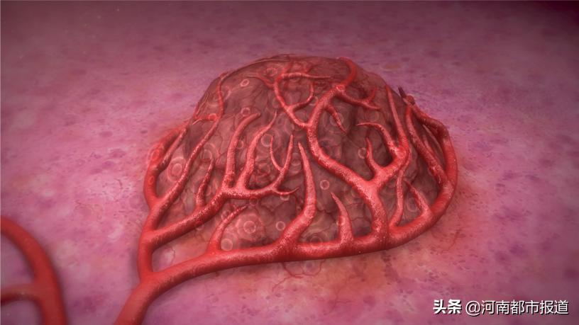 国内首例钇90微球治疗成功,肝癌系统治疗新进展