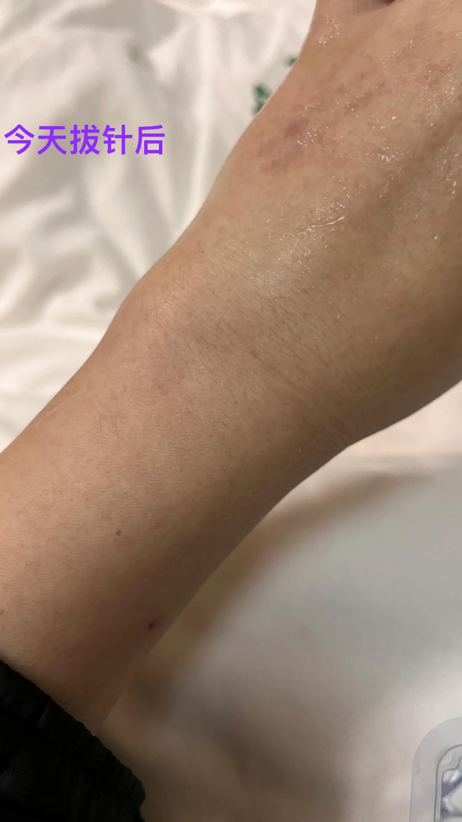 从早上不到十点打点滴到现在（晚八点）！本来是两瓶...