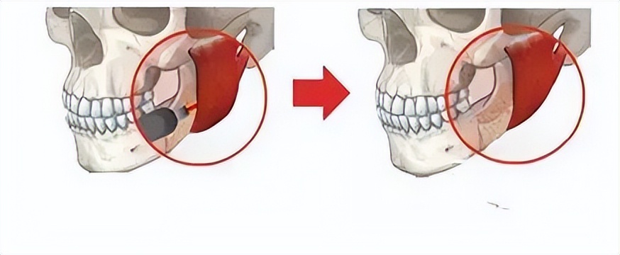 咬肌切除手术和瘦脸针,瘦脸针和咬肌切除该怎么选