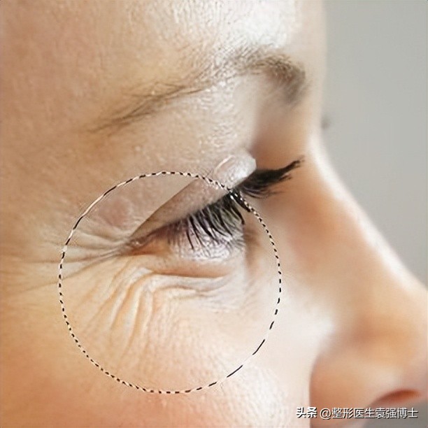 如何解决眼周衰老症状,眼周肌肤出现衰老怎么办