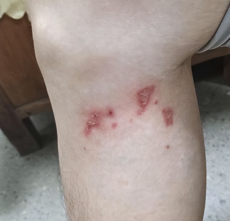 甲硝唑一瓶多少钱,甲硝唑多少钱一盒10粒装