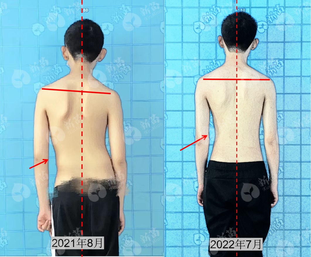 青少年脊柱侧弯如何自我矫正,青少年脊柱侧弯自我矫正